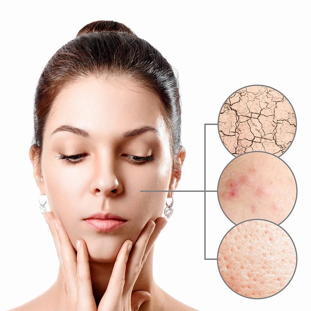 Blackheads and Impurities Remover (4 Suction Heads)