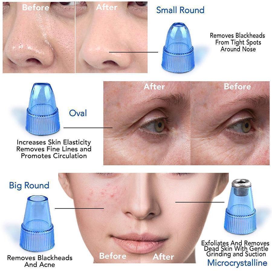Blackheads and Impurities Remover (4 Suction Heads)